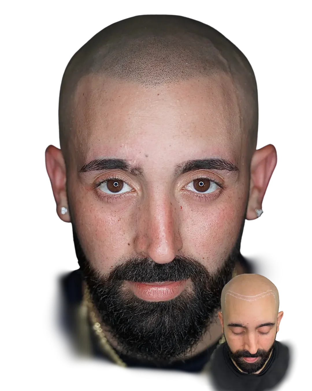 Matched to the beard. Healed scalp micropigmentation result by Stevey G, before shown inset.