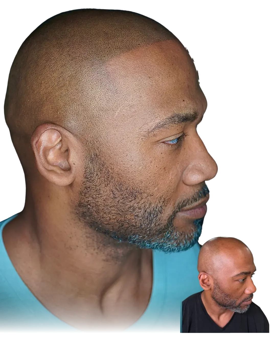 Deep skin, true value. Healed scalp micropigmentation result by Stevey G, before shown inset.