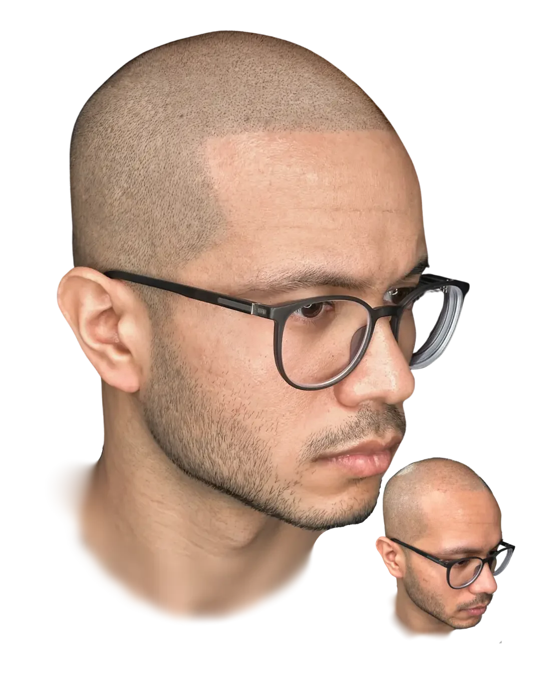 The profile test. Healed scalp micropigmentation result by Stevey G, before shown inset.