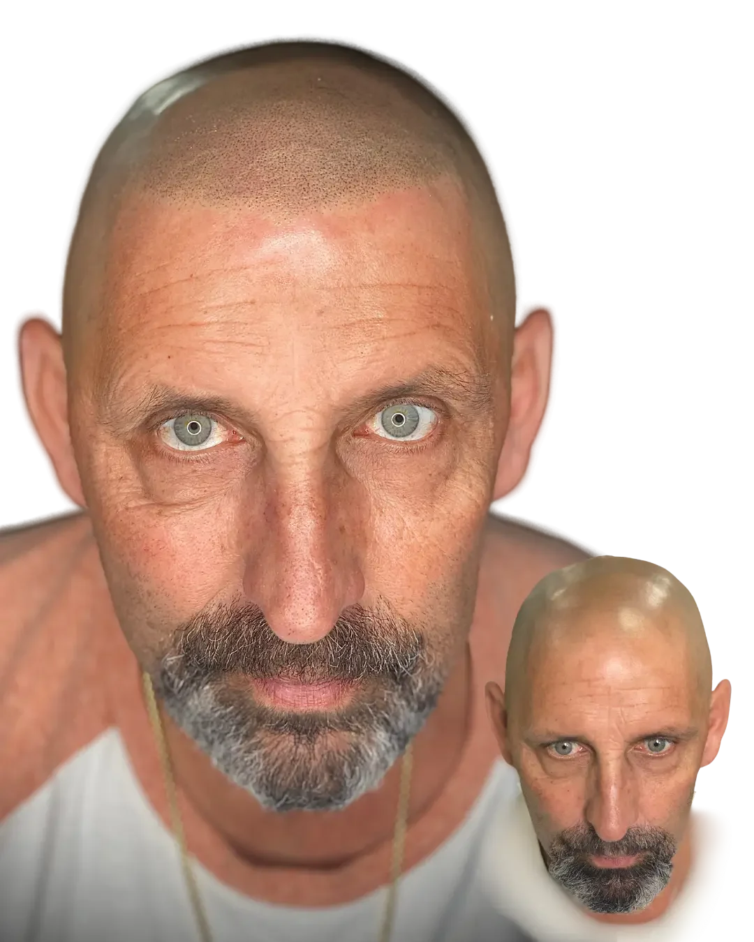 Density against grey. Healed scalp micropigmentation result by Stevey G, before shown inset.