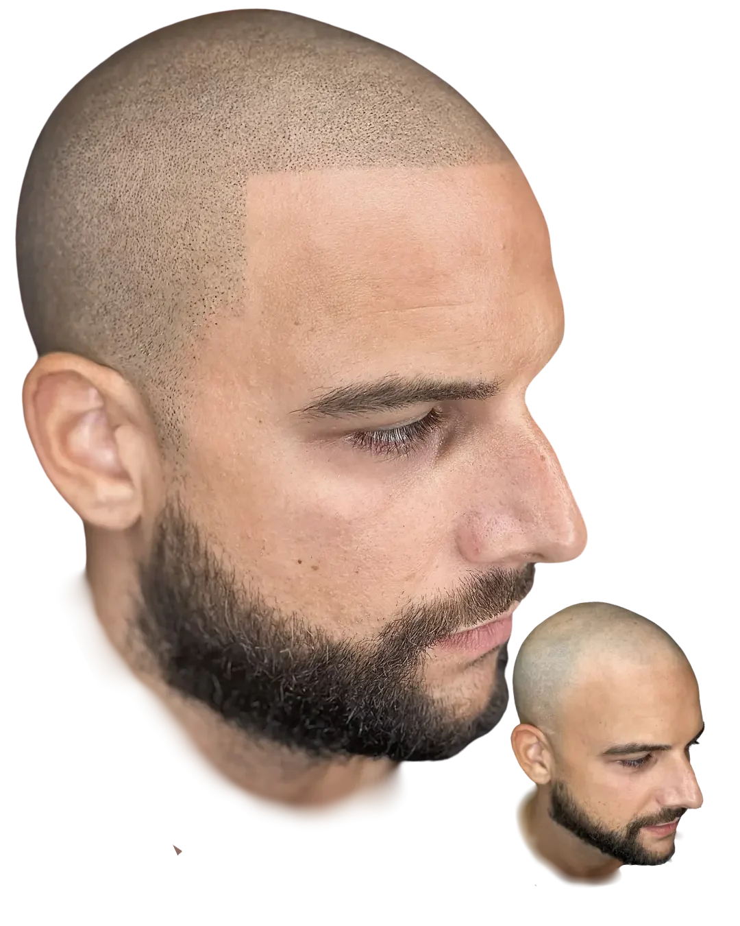 Sharp from the side. Healed scalp micropigmentation result by Stevey G, before shown inset.