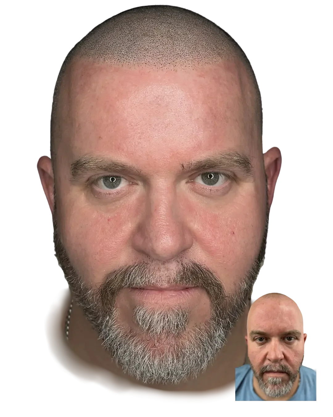 Framing the face. Healed scalp micropigmentation result by Stevey G, before shown inset.