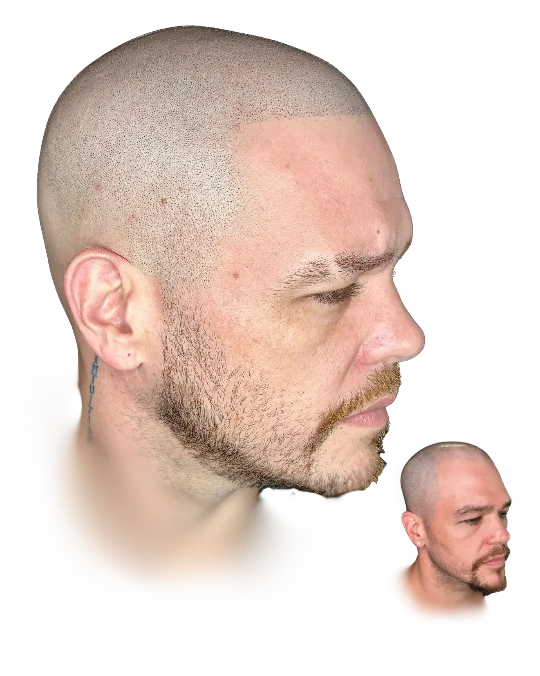 Built for the profile. Healed scalp micropigmentation result by Stevey G, before shown inset.